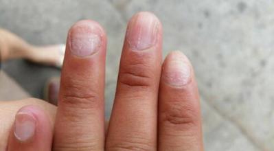 治疗灰指甲需要注意哪些事项